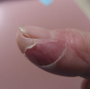 skin peeled off finger #10