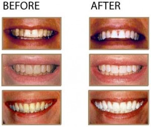 2Teeth will easily whiten regardless of its color