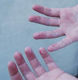 What causes skin peeling on fingertips