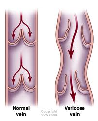 10. Maintain your weight to avoid varicose veins